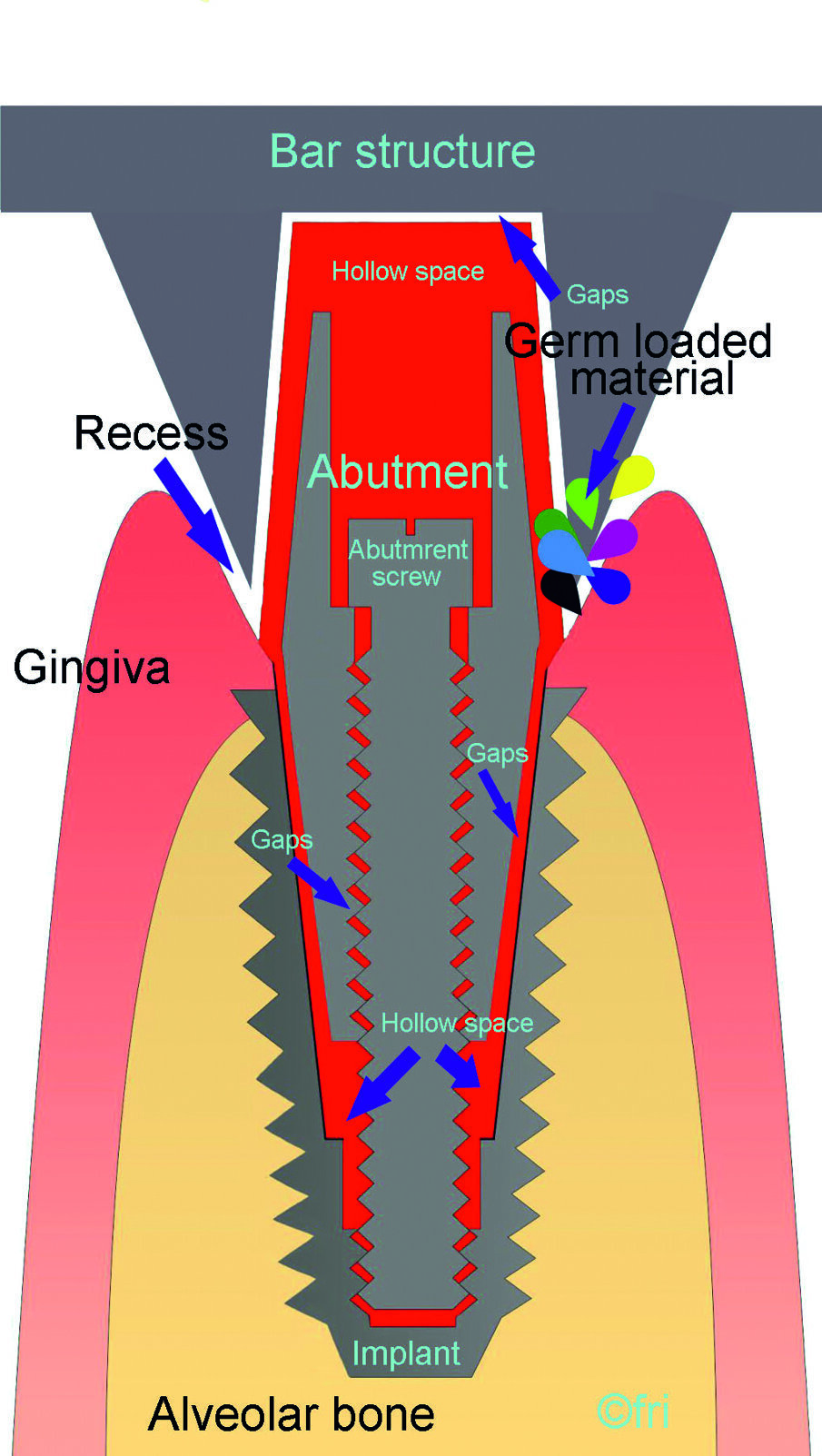 Fig. 1: Schematic representation of a multipart endosseous implant with a bar construction. The recesses, hollow spaces and gaps in the implant and the superstructure are marked with arrows.
