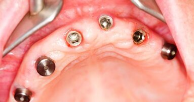 Оцеляването на денталните импланти при диабетици и здрави пациенти може да бъде еднакво успешно