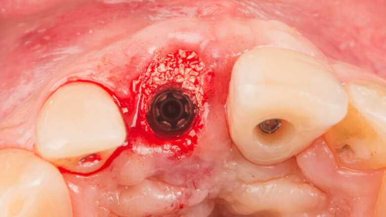 Immediate placement and restoration of a Straumann BLX implant replacing maxillary incisors