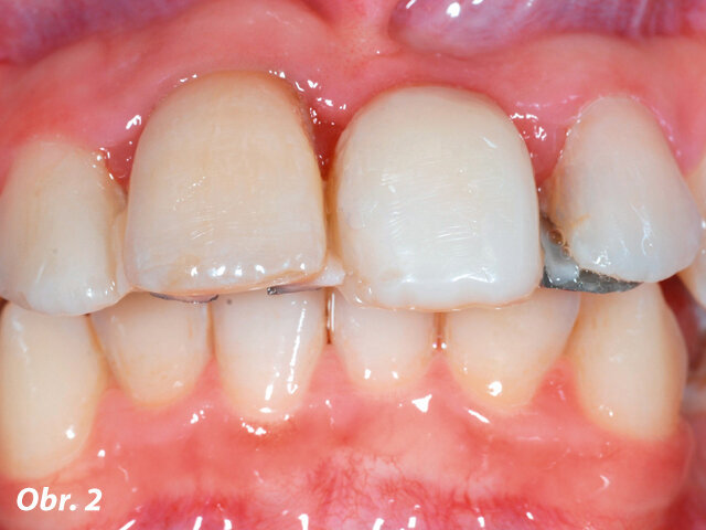 Obr. 2: Po sejmutí a refixaci vykazoval adhezivní můstek kompromisní dosed