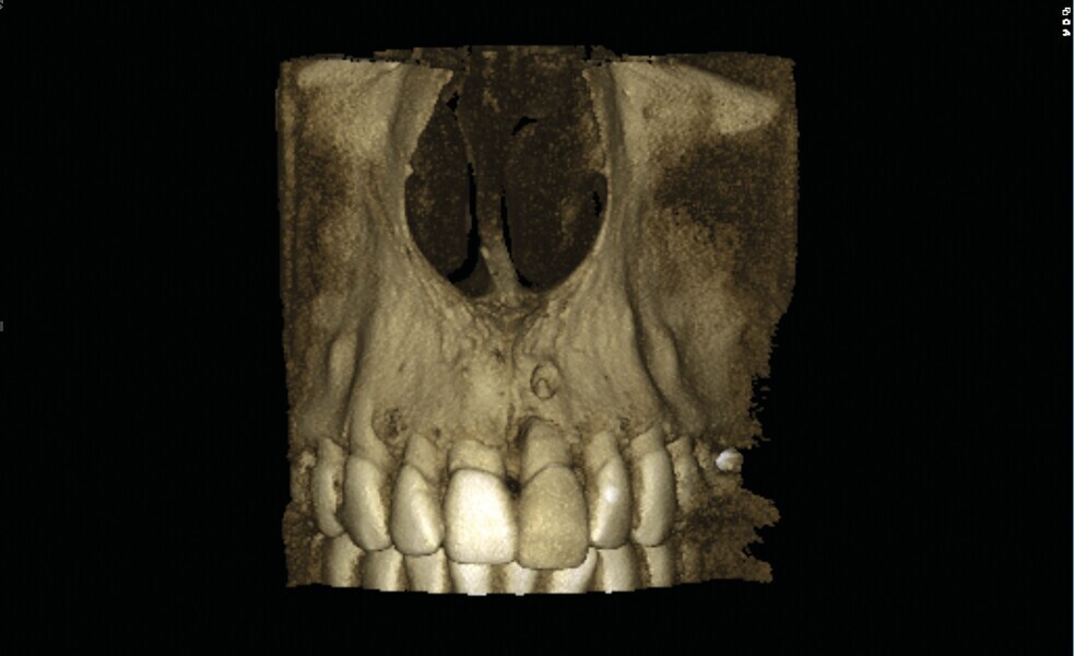 Fig. 2 : Image CBCT en 3D des structures osseuses (b). La lésion périapicale est mise en évidence. 