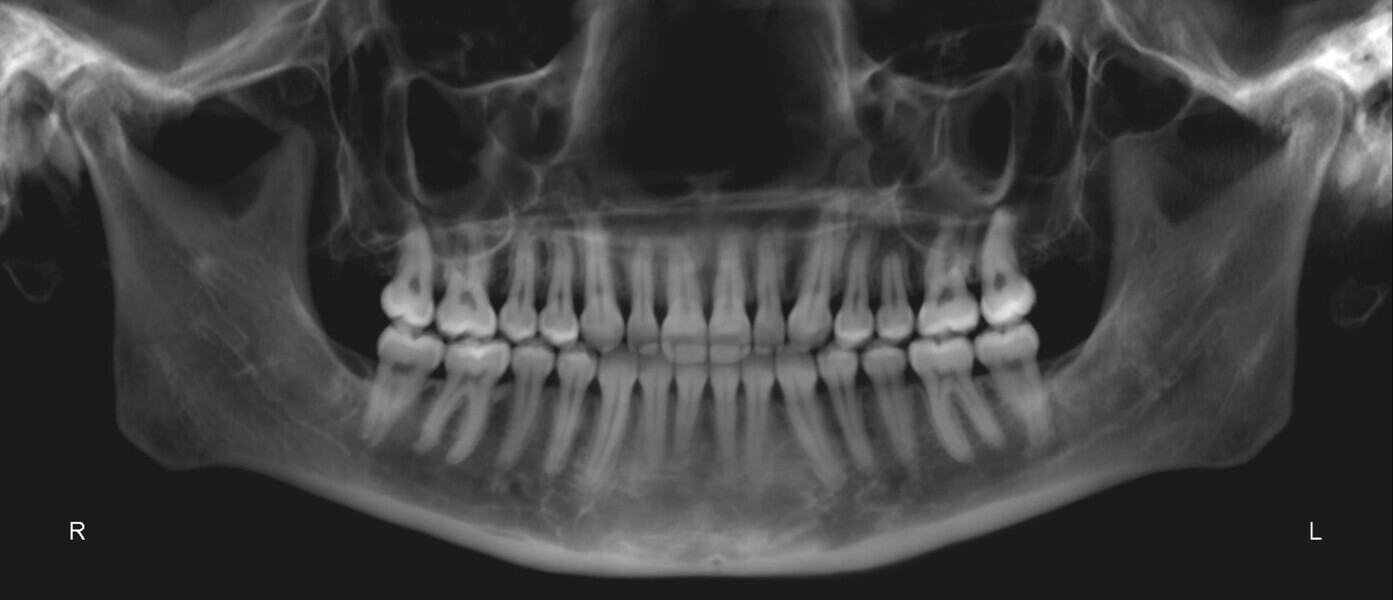 Fig. 32: Post-treatment panoramic radiograph.