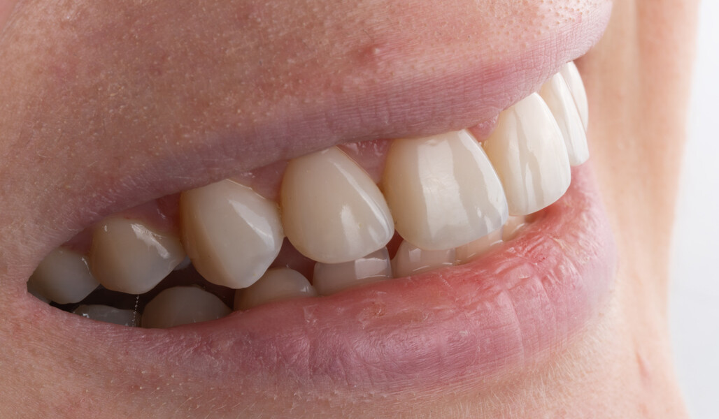 Fig. 9d: : Final treatment outcome. Extra-oral close-up smile view.