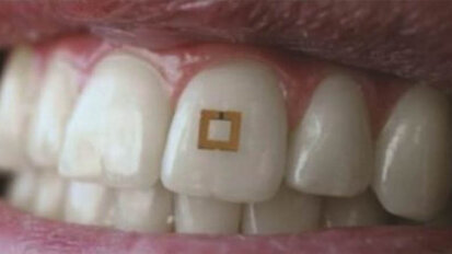New tooth-mounted microchip tracks ingested food New tooth-mounted microchip tracks ingested food