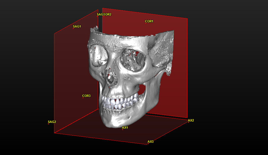 Figg. 5, 6_Piani di riferimento per la costruzione dell’analisi cefalometrica 3D, secondo la metodica cefalometrica Total Face Approach.