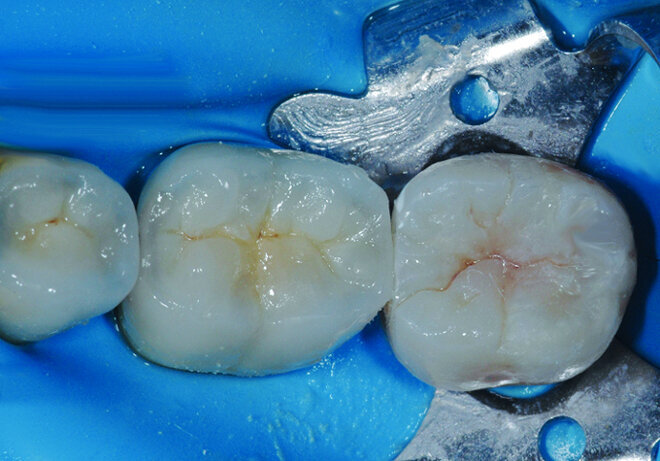Fig.4 : Vue clinique lors du collage sous digue de l’onlay composite.