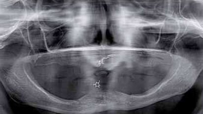 Rehabilitacja implantoprotetyczna w silnej atrofii wyrostka zębodołowego w zespole Kellego