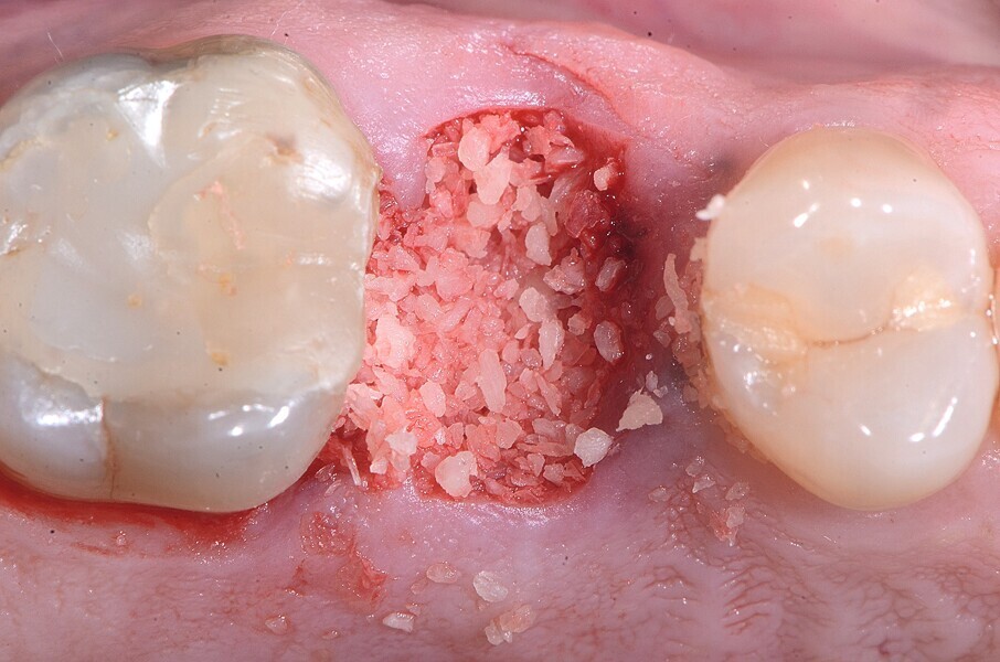 Fig. 16 : Allogreffe osseuse aux fins de la préservation de l’alvéole. 
