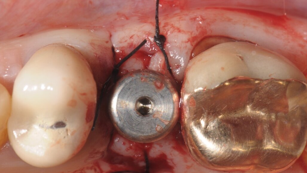 Impianto post-estrattivo, immediato o ritardato? Scelta razionale, tecnologicamente supportata