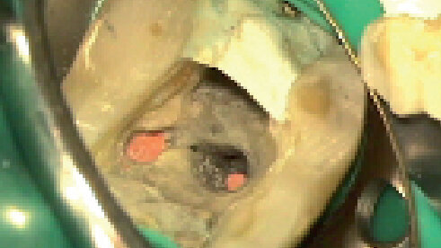 Reendodontické ošetrenie dolného molára