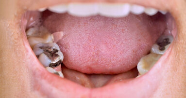 BDA Northern Ireland labels dental amalgam phase-out “unworkable”