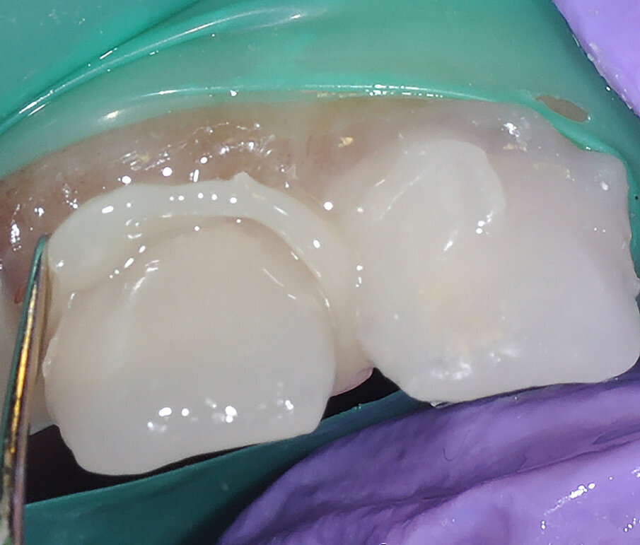 Fig. 8: Excess cement removed from margins prior to final cure.