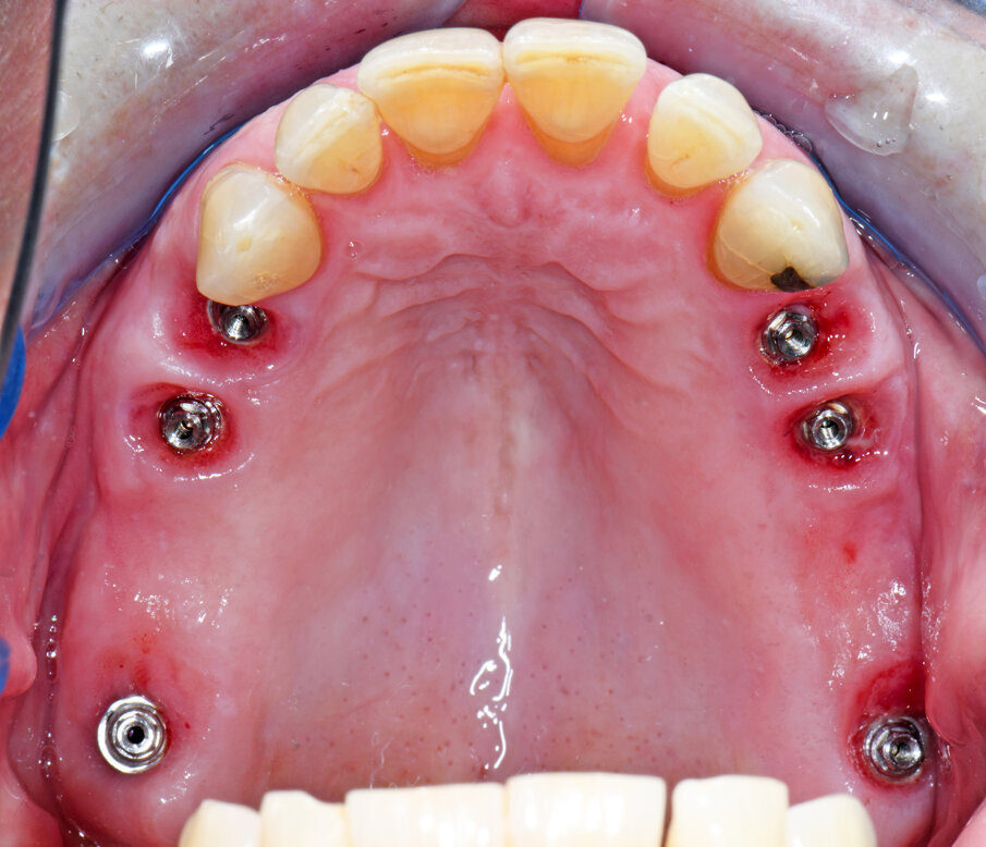 Obr. 6: Hojení měkkých tkání po šesti měsících.