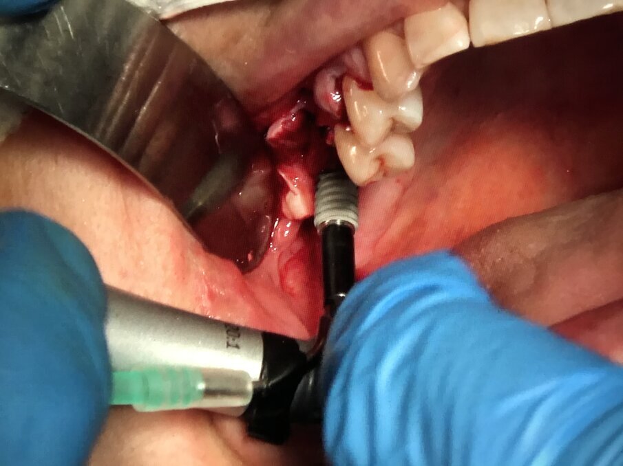 Fig. 18 - Sinus lifting: dopo l’inserzione di due impianti Multysytem si riempie la neo-cavita sotto Schneideriana con I-PRF addizionato a xenoinnesto osseo.
