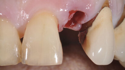 Sostituzione immediata mediante impianto e restauro immediato in sede incisivo laterale superiore