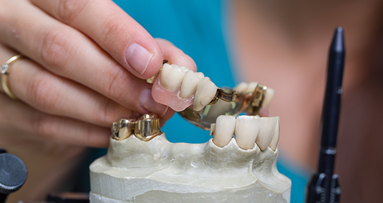 Adhäsivbrücken mit Metallgerüst jetzt GKV-Leistung