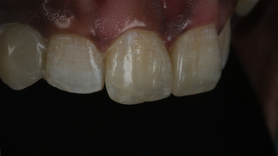 Fig 25. Defining line angles and their perfect contour helps establish an aesthetic shape and hence a pleasing end-result.