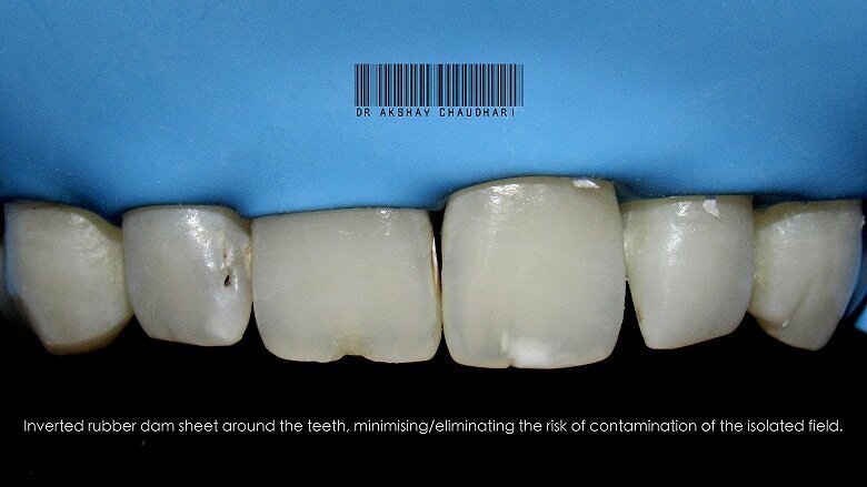 Fig - 6 Rubber dam inversion