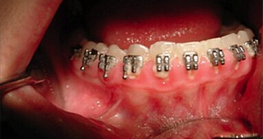 Gengivoplastica eseguita con Laser CO<sub>2</sub> coadiuvato dalla tecnologia LED