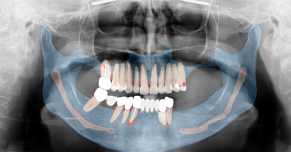 Fig. b: Pre-op panoramic radiograph and the findings.