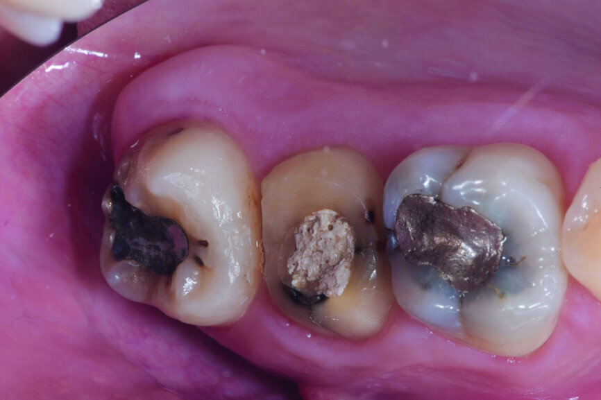 Fig. 1: Pre-op occlusal view.
