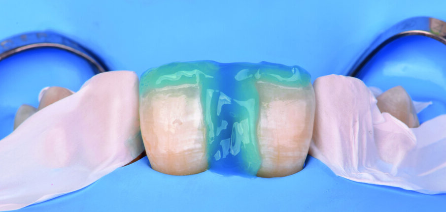 Fig 8. Selective etching of the enamel surface with Phosphoric Acid