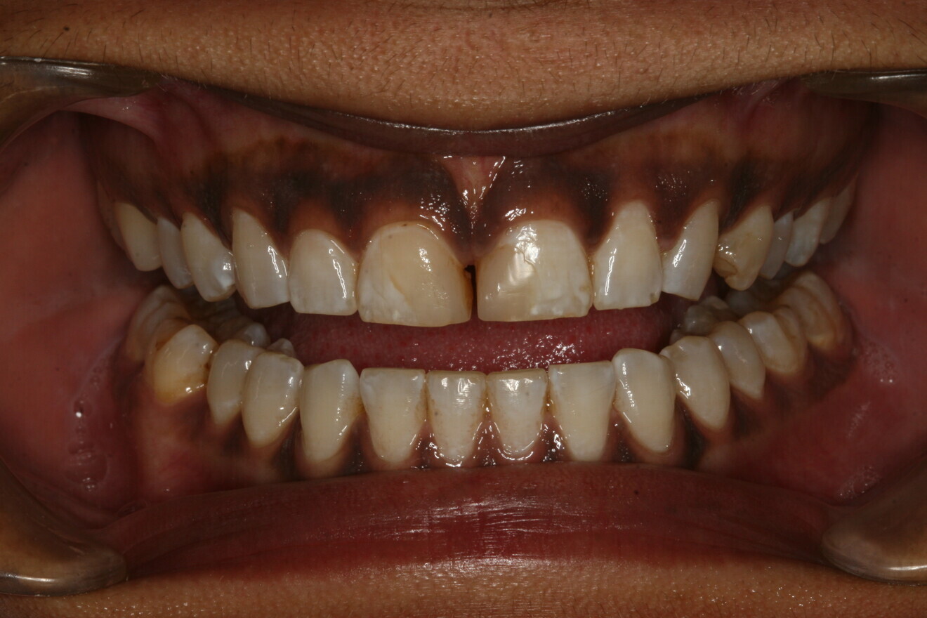 Fig. 2: Pre-op retracted view showing the diastema and improper proportions of the width-to-length ratios.