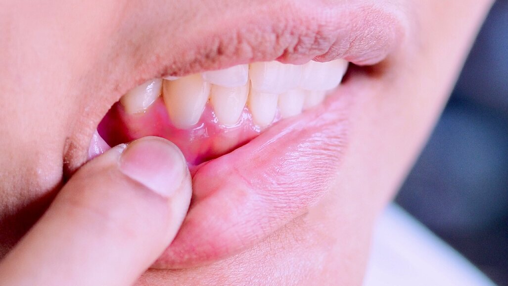 Un nuovo studio spiega il legame tra obesità e malattia parodontale