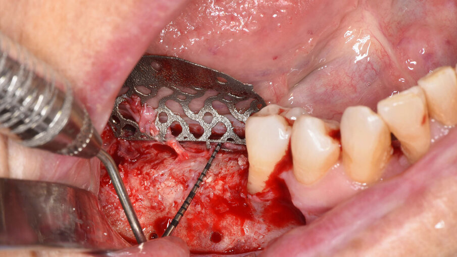 Figg. 9a-9c_Foto intra-operatoria durante la rimozione della griglia in titanio che evidenzia l’incremento osseo ottenuto e l’assenza di perdita ossea al di sotto della griglia.