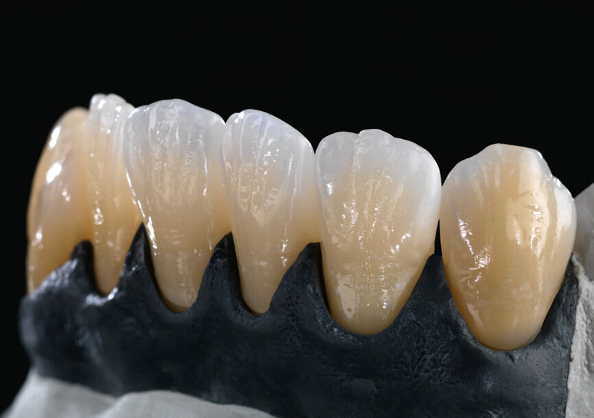 Im Jahr 2014 brachte Amann Girrbach mit Zolid FX White das erste Zirkonoxid für monolithische Frontzahnrestaurationen auf den Markt. © Amann Girrbach