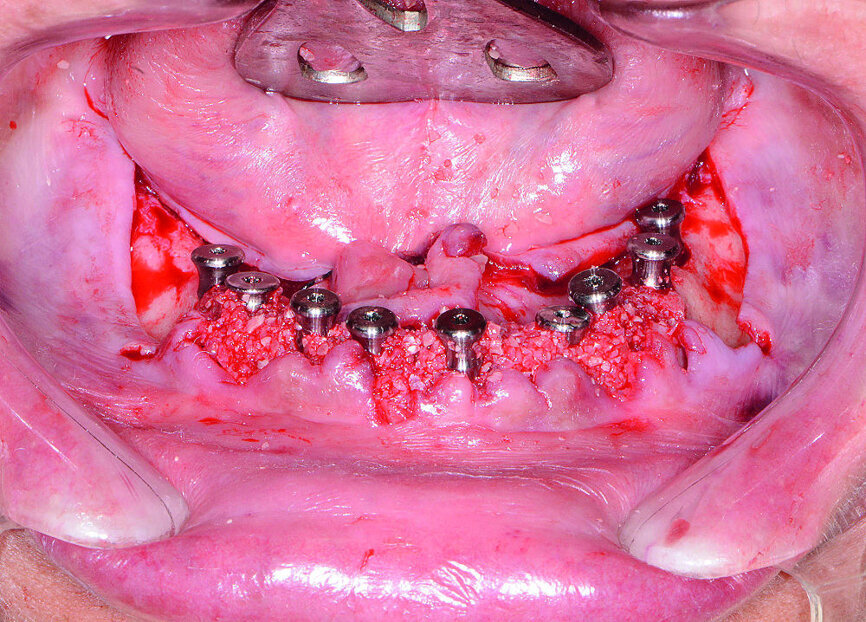 Fig 15 Implants et coiffes de cicatrisation entourés du matériel de greffe