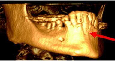 Eziologia dei diversi tipi di insuccesso in implantologia orale