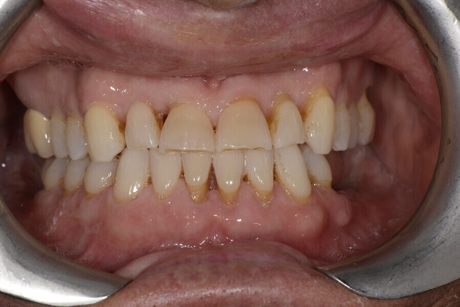 Figs. 19a–e: Situation after the first series of aligners and mandibular implant placement, showing alignment and anterior spacing due to maxillary arch expansion.