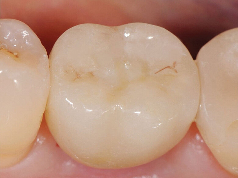 Fig. 12: Crown with composite closure of screw access channel. (Photo: Jens Tartsch, DMD)