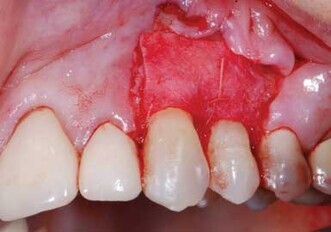 SYMBIOS offers solutions for regenerative needs SYMBIOS offers solutions for regenerative needs