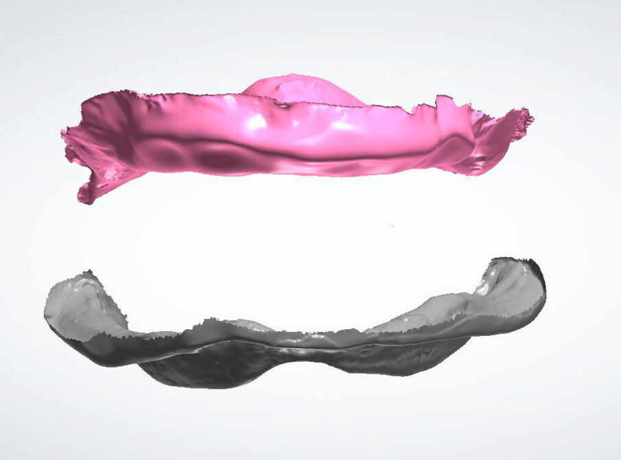 Fig. 5_La rimozione virtuale della Toronto superiore con software exocad.
