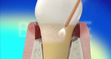 BIOLASE REPAIR Perio protocol shows superior results in study