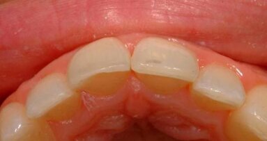 Prosta technika warstwowa do wypełnień kompozytowych wykonywanych metodą bezpośrednią