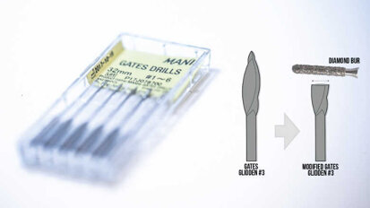 Gestion d’instruments intra canalaires fracturés : étude de cas clinique