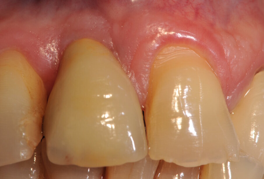 Fig. 12_Corona definitiva a 1 anno dalla cementazione. Notare la chiusura degli spazi interprossimali.