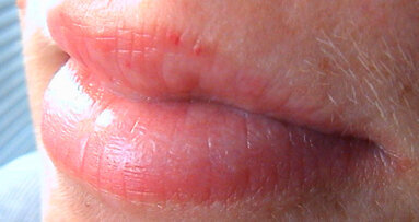 Il Botulino in Italia, un mercato in crescita: +18% dove il paziente tipo è donna tra i 35 ed 55 anni