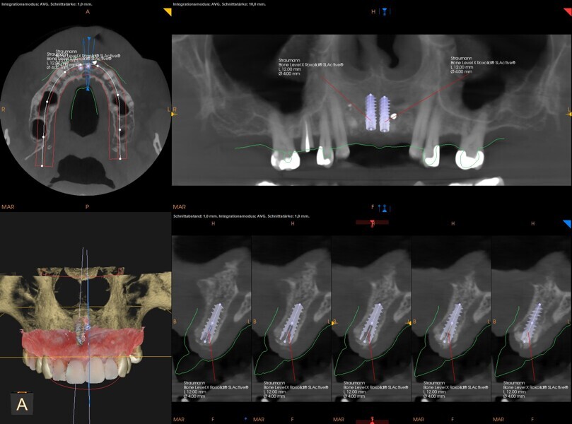 Fig. 10: Final planning for two implants with merged intra-oral scan and CBCT data.
