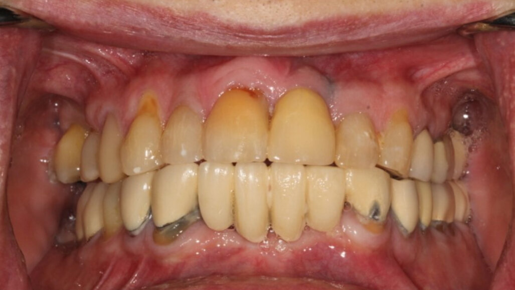 Immediate full-arch zirconia implant therapy utilising the power of robotic assistance and digital scanning