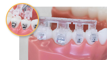 Providing orthodontists with clinical freedom and workflow efficiency