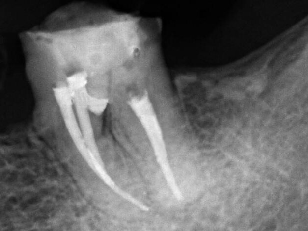 Figs. 5: Clinical and radiographic appearance of drilling filling with MTA Repair HP.