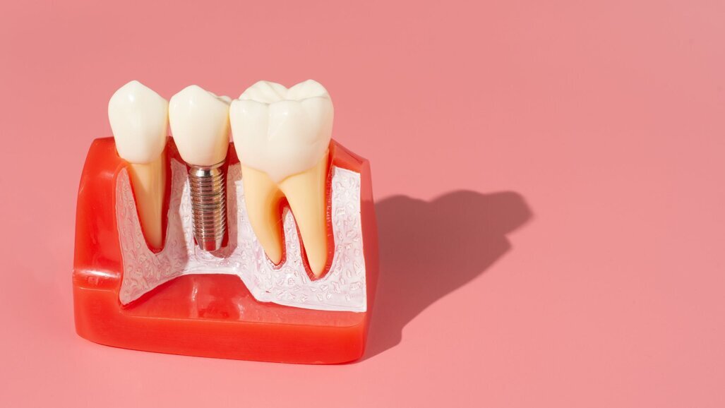 Onderzoek toont risicofactoren voor vroegtijdig implantaatfalen