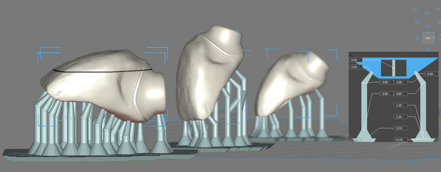 Figg. 8, 9_L’orientamento dei modelli o degli oggetti da stampare influenzerà l’ingombro, la velocità e il tipo di supporti e la quantità di essi. Pochi supporti potrebbero creare aree di cedimento, troppi supporti creerebbero aree di imperfezione, orientare una corona con il bordo incisale in alto creerà dettaglio sul bordo stesso riducendo la precisione del dettaglio con l’Interface/Ti-Base, il contrario permetterà di avere tanta precisione sull’interfaccia con l’abutment ma meno su bordo incisale. 