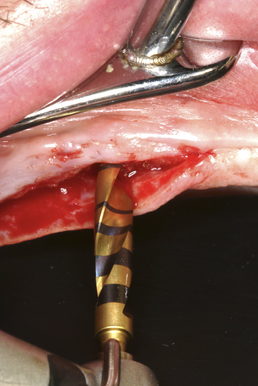 Coronal perforation of the cortical layer with drill #4 (5c).