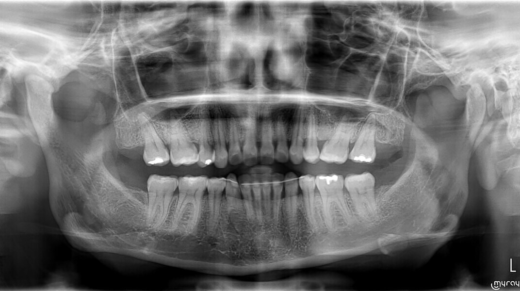 Fig. 10b: Final cephalometric radiograph and dental panoramic tomogram.