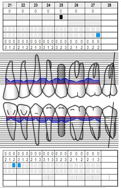 Fig. 12 - Sondaggio parodontale postoperatorio (follow-up a 5 anni).